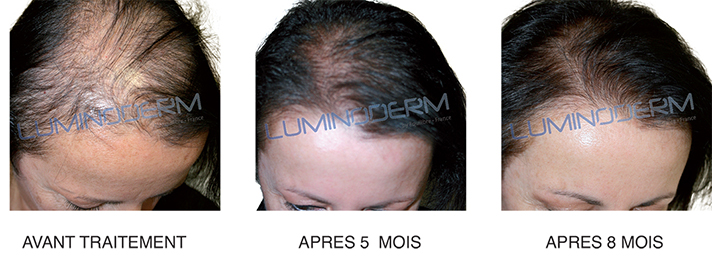 Effluvium Cheveux Avant Après